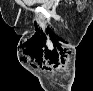 Figure 5 for case Necrotizing fasciitis ( RID3447 )